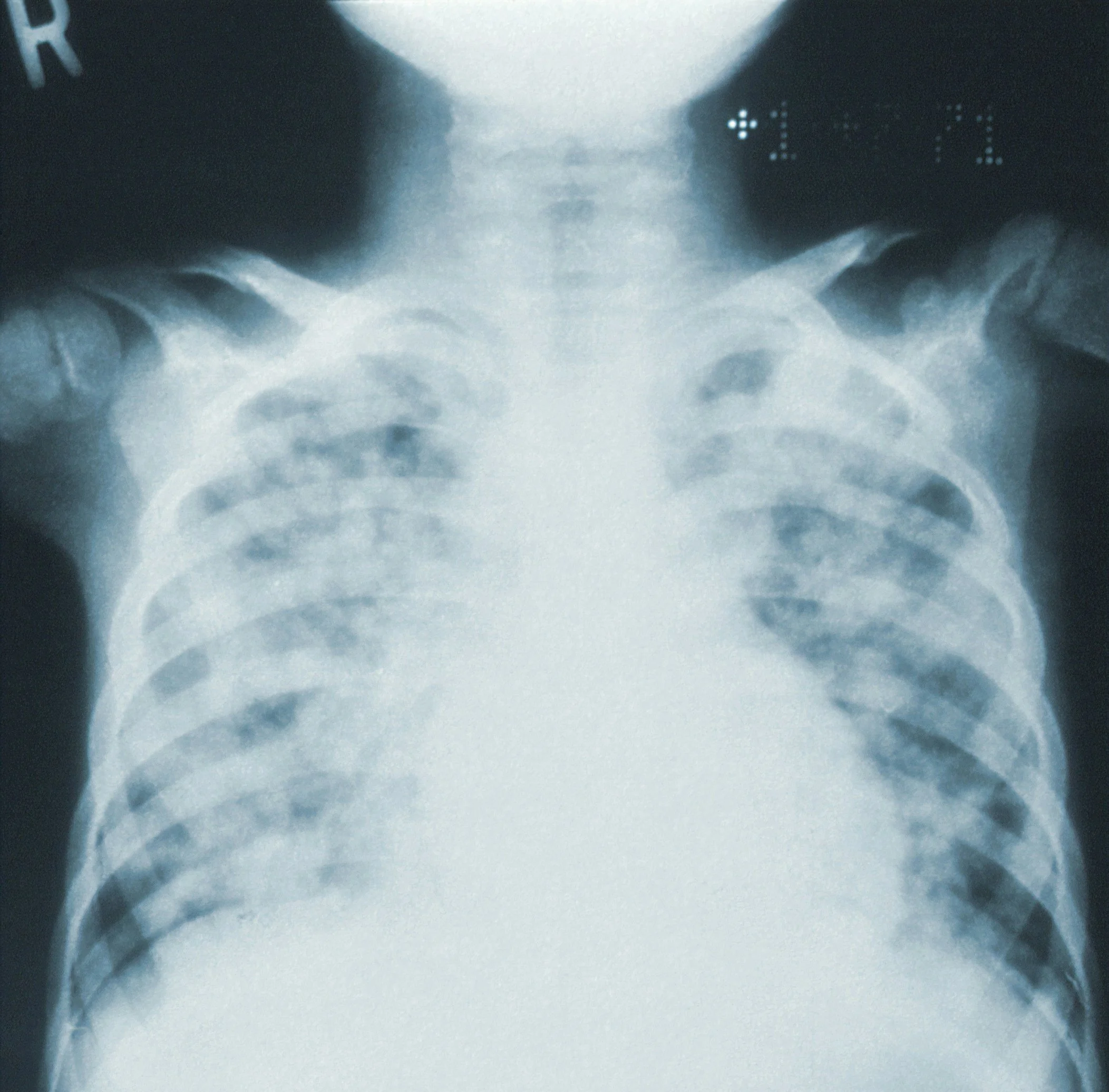 x ray of a broken bone